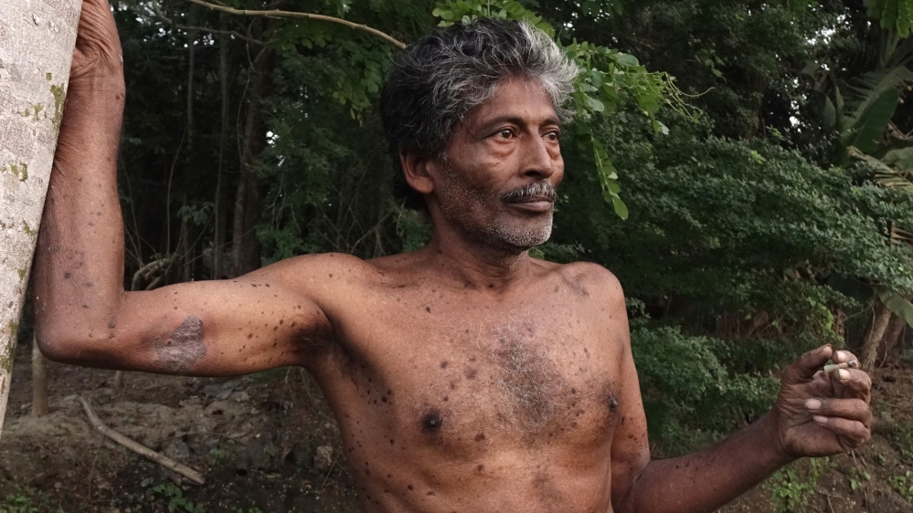 Manatosh Biswas, 51, is suffering from Bowen's disease - a pre-cancerous condition from drinking arsenic-contaminated water before the lesions appeared all over his body. He kept drinking the contaminated water in spite of warnings from doctors for almost 14 years because he could not afford to buy regular bottled drinking water [Shaikh Azizur Rahman/Al Jazeera]