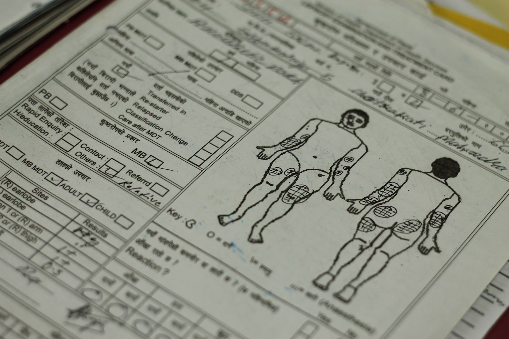 LEPROSY, Nepal/ Please Do Not Use