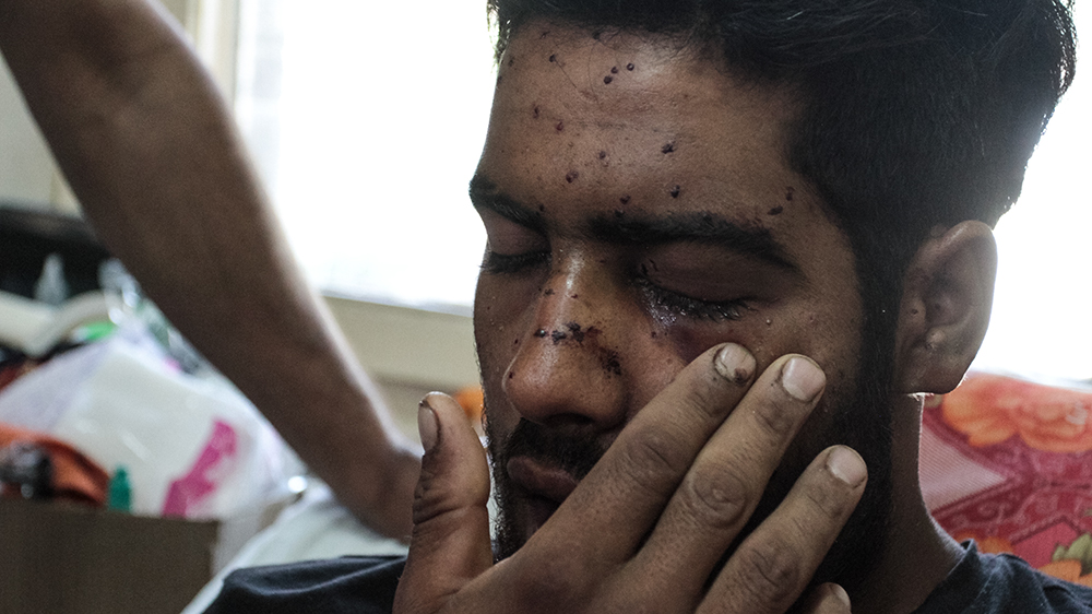 Khalid Arif, 19, a plumber from Budgam, was hit in the eyes with pellets on September 14. His mother, Taja, told Al Jazeera that he was distributing meat to family members around the town when he found himself in the middle of clashes [Shuaib Masoodi/Al Jazeera]