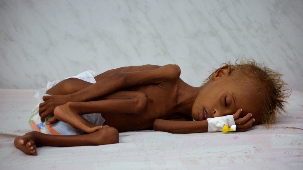 A Yemeni child lies on a bed at a malnutrition intensive care unit at a hospital in the Red Sea port city of Hodeida