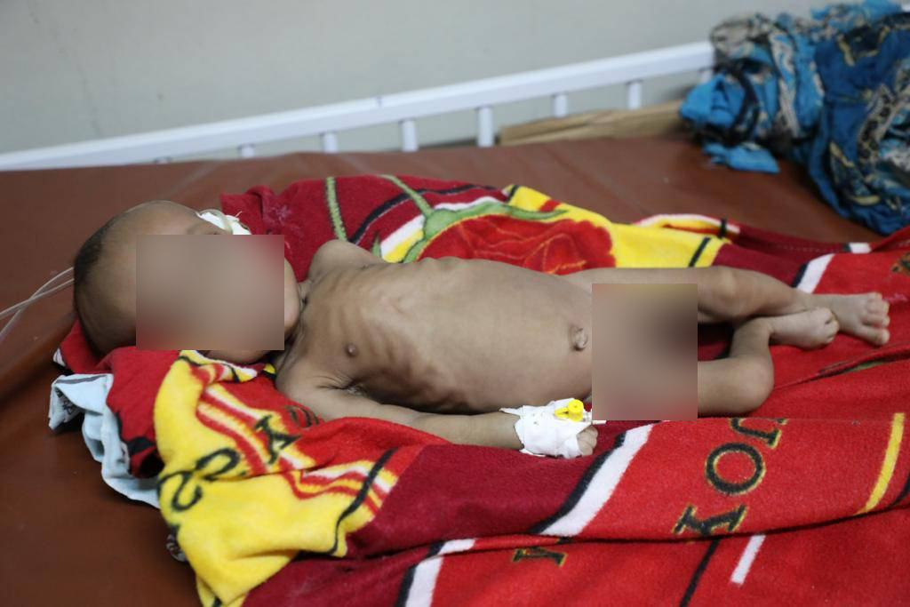 Haftom Hailay receives care at Ayder Referral Hospital in Mekelle [Courtesy Al Jazeera]