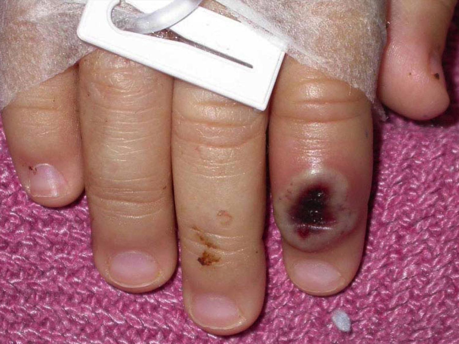 A monkeypox blister on the finger of a patient in hospital with the disease