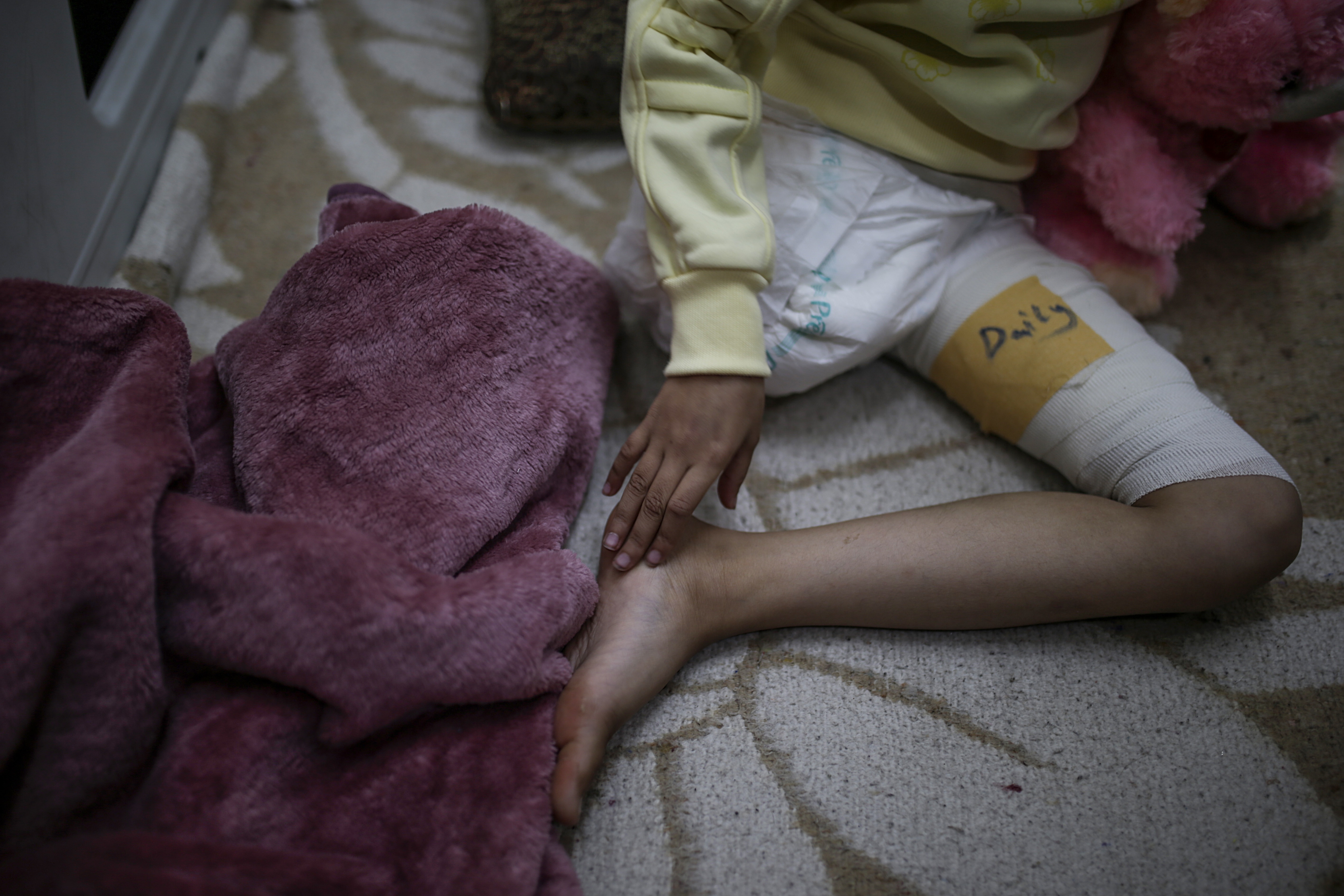 epa11793286 Nine-year-old internally displaced Palestinian girl Heba Muhanna, who had her right leg amputated, sits on a bed at the Al Aqsa martyrs hospital in Deir al Balah, central Gaza Strip, 24 December 2024 (issued 25 December 2024). Heba fled with her family from the northern Gaza Strip to the south after October 2023. Following Israeli airstrikes on the Al Nusairat refugee camp on 12 December 2024, Heba lost her father as well as five uncles, and had her leg amputated. According to a December 2024 report by the UN Palestine refugee agency UNRWA, Gaza currently has the highest number of child amputees per capita anywhere in the world.