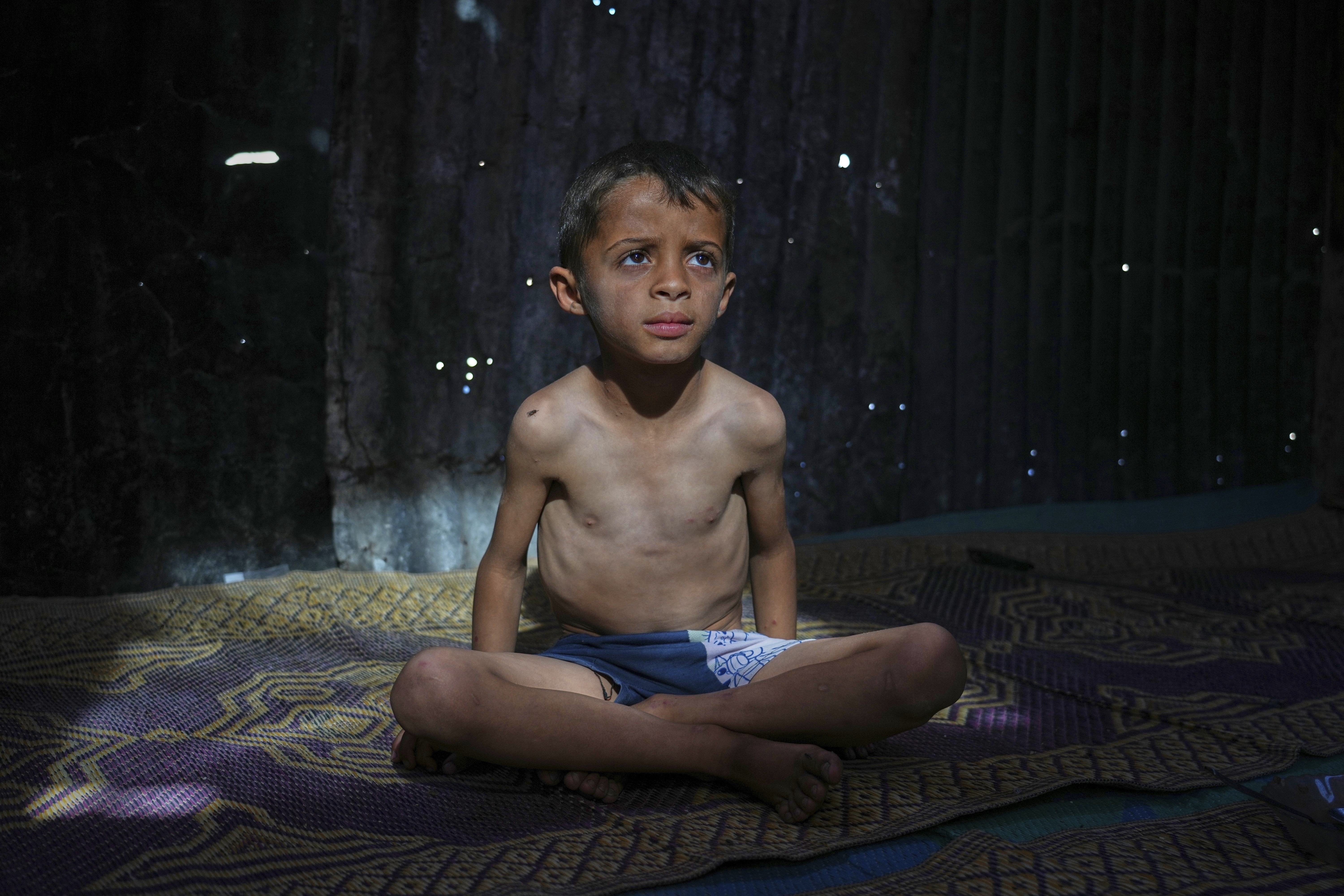 Gaza malnourished children