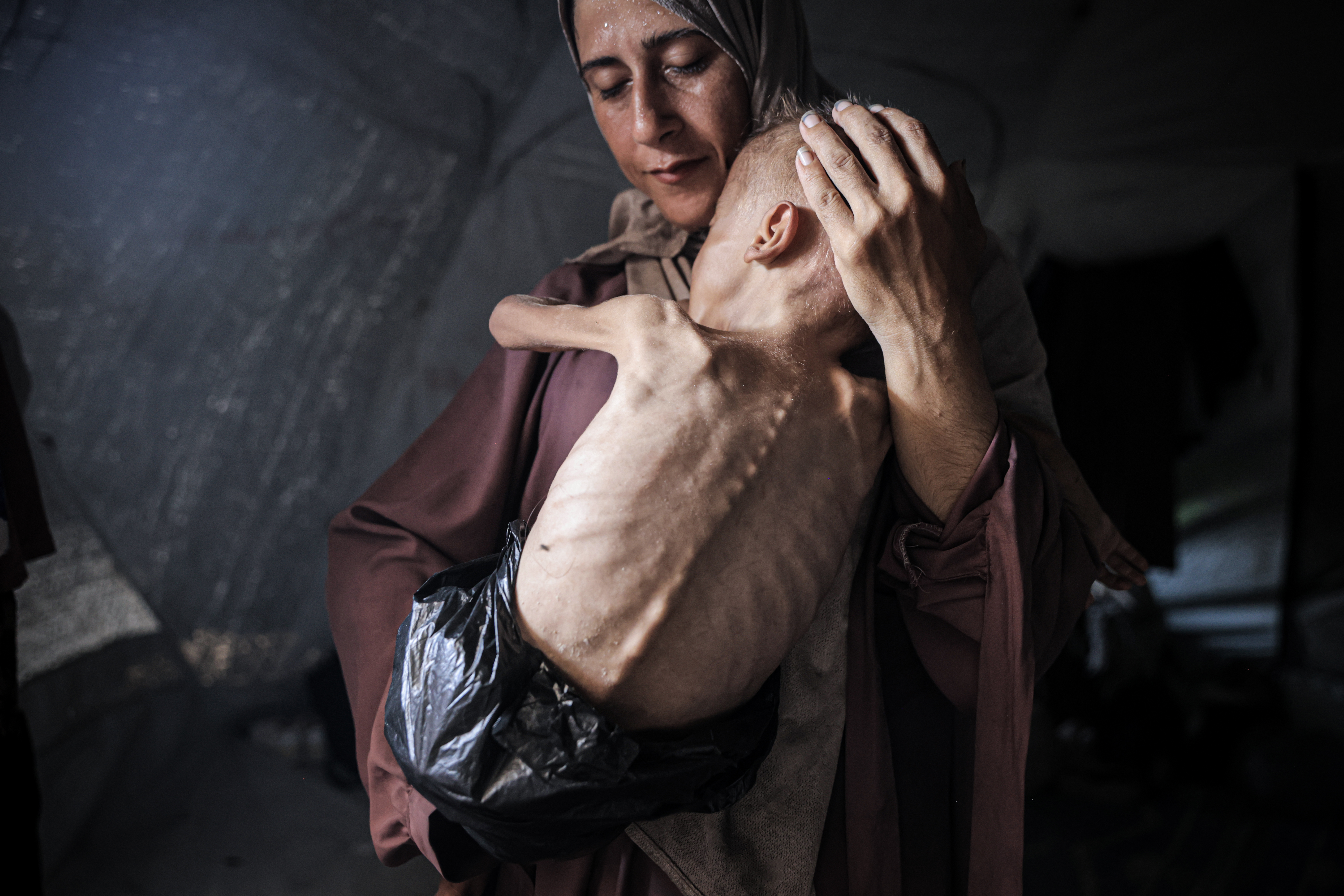 A mother holds her malnurished toddler amidst the war.