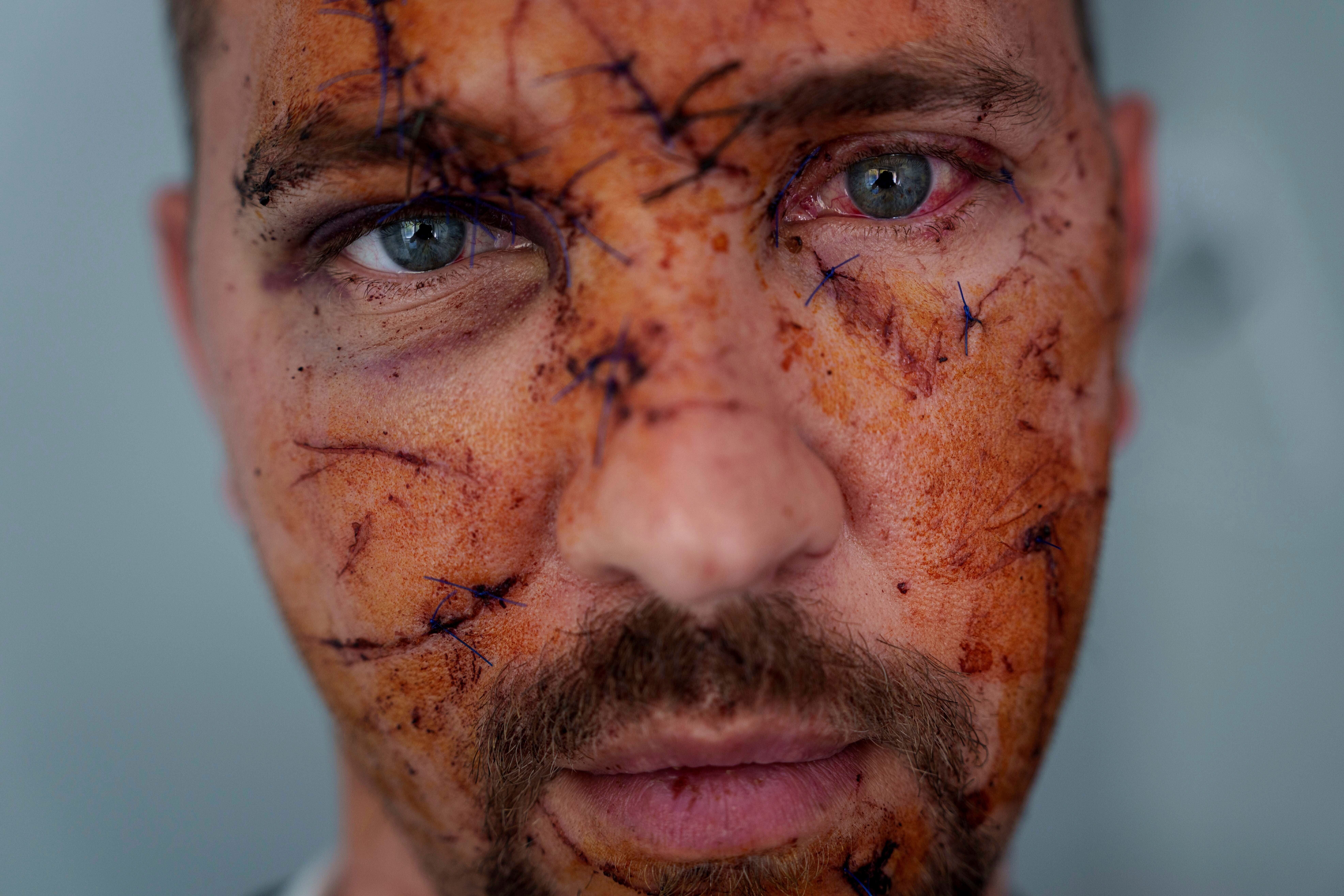 Multiple wounds can be seen on the face of Kostiantyn Bychek during a hospital visit in Kyiv